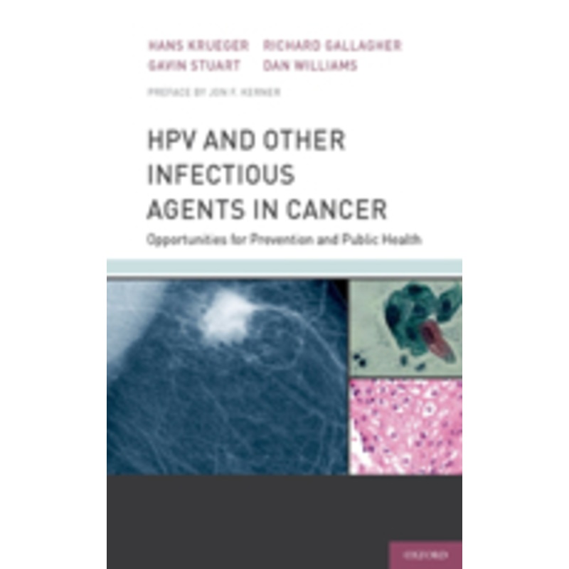hpv and other infectious agents in cancer: opportunities for prevention and public health